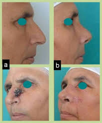 The good news is many cases of lung cancer are believed to be preventable, as an estimated 90% of lung cancer cases are caused by active smoki. Esthetic Rhinoplasty As An Adjunctive Technique In Nasal Oncoplastic Surgery Sciencedirect
