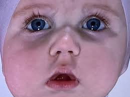 Fundraiser by Aubrey Hess : Support Rhea's Urgent Helmet Treatment