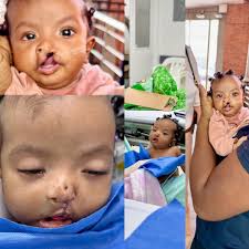 Day six of the Rotaplast surgical clinic in Kampala, Uganda, highlights the  Rotaplast team's dedication to providing high-quality care and fostering  community connections. Central to our success are invaluable mission  partners and