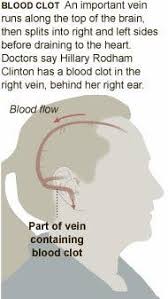 ■ have had recent surgery. Hillary Clinton Is Discharged From Hospital After Blood Clot The New York Times
