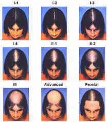 Top 4 signs of female hair loss. Early Signs Of Hair Loss In Men And Women