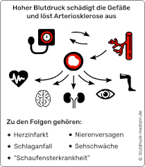 Bluthochdruck Arteriosklerose Herzinfarkt Und Andere Folgen Blutdruck Medizin