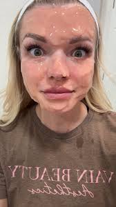 I still need a few Lipo-dissolve models for the following areas: •Chin ✓  •Lower abdomen ✓ •Upper abdomen •Bra bulge •Love handles •Thighs ✓ Deposit  required• October dates available 😍