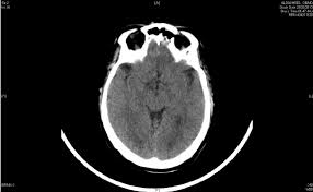 How long does it take to get cat scan results back? Ct Scan In Er Ct Scan Machine
