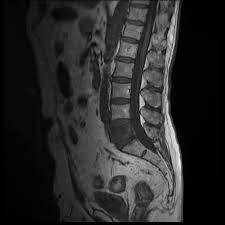 The pancreas is a bodily organ that few people think about. Vertebral Metastases From Prostate Cancer Radiology Case Radiopaedia Org