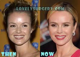 The britain's got talent star, 50, flashed her pearly whites as she donned a. Amanda Holden Plastic Surgery Botox Facelift Botox Facelift Botox Amanda Holden