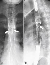 ( a from levine ms: Esophagus Clinical Gate