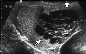 Most such lesions occur in paratesticular tissues and are cystic in nature. A 56 Year Old Man With Dilated Rete Testis Or Tubular Ectasia Download Scientific Diagram