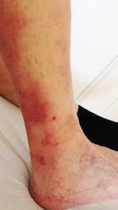 Image result for erysipel photos)