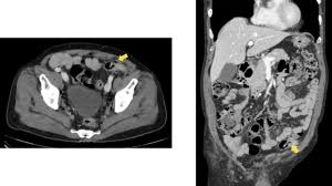 A tumor is a solid or cystic mass. Laparoscopic Removal Of Mesh Migrating Into The Sigmoid Colon After Totally Extraperitoneal Tep Laparoscopic Inguinal Hernia Repair With Positive Faecal Occult Blood Test Bmj Case Reports
