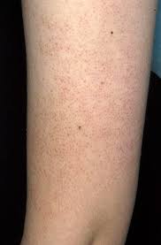 Image result for Keratosis pilaris