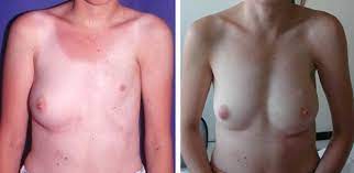 Kostenübernahme durch krankenkasse methoden ablauf ärzte. Autologous Fat Injection In Poland S Syndrome Sciencedirect