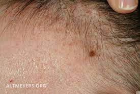 Staphylococcus aureus increases the horn at the hair follicle. Keratosis Pilaris Syndrome Overview Altmeyers Encyclopedia Department Dermatology