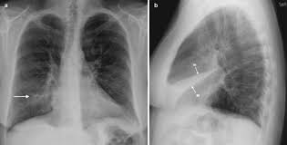 Factors that make you more likely to develop atelectasis include: Atelectasis Amboss