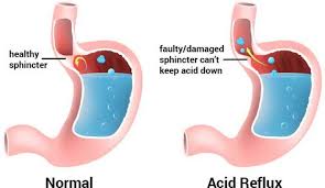 People usually describe this phenomenon as heartburn. Acid Reflux Strategy How To Get Rid Of Acid Reflux In Throat