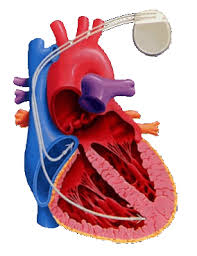 Das herz braucht einen elektrischen impuls, um sich zusammen zu ziehen. Herzschrittmacher
