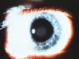 Post-Prk Corneal Haze Before (A) And After (B) Treatment With Stromal... |  Download Scientific Diagram