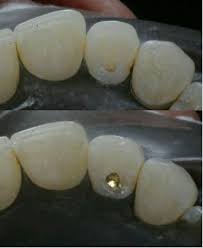 Treatment of cavities depends on their severity, but dentists typically recommend the following treatments for small cavities: How Much Does It Cost To Get A Cavity Filled Dental Health Society