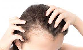 Your hair is thinning,'  keaney said. Female Pattern Baldness Causes Treatment And Prevention