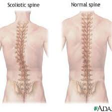 The colon is divided into four parts: Normal And Abnormal Spinal Curvature Download Scientific Diagram