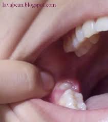 Sinuslift mexico cost $250 usd to $1,000 usd Wisdom Teeth Removal Cost Philippines Teethwalls