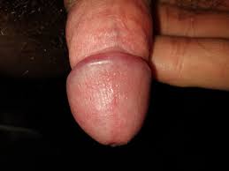 Красные пятнышки на пенисе