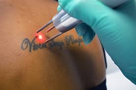 Common techniques used for tattoo removal include laser surgery, surgical removal and dermabrasion. Tattoo Tips And Facts Statistics