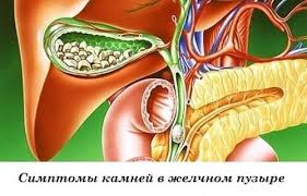 как избавиться от камней в желчном пузыре народными методами Zhelchnyj Puzyr Eto Organ Kotoryj Imeet Meshkoobraznuyu Formu Zdorove Puzyri Zdorovye Zuby