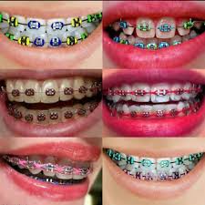 Untuk memasangnya, anda perlu membayar biaya pemasangan yang tak. Braces Trend Atau Keperluan 5 Perkara Ini Anda Perlu Tahu Sebelum Pakai Braces Gaya Hidup Cari Infonet