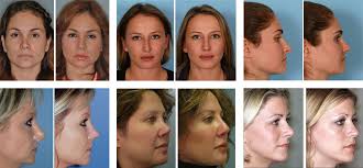 Image result for ‫جراحی بینی ثانویه‬‎