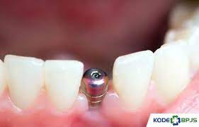 Yang saya tanyakan apakah pasang gigi palsu ditanggung bpjs ? Harga Gigi Palsu Di Puskesmas 2021 Permanen Lepasan Kodebpjs