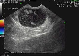 Maybe you would like to learn more about one of these? Gynaecological Pelvic Scan Diagnostic Ultrasound
