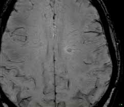 Widespread use of mri (magnetic resonance imaging) has revolutionized the ability to diagnose multiple sclerosis. Central Vein And Iron Rim Sign Radiology Case Radiopaedia Org