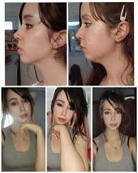 Maybe you would like to learn more about one of these? This Just Goes To Show How Much Losing Face Fat Can Do Albeit She Is Clearly Jutting Her Jaw Forward In The Left Photo Mewing