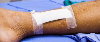 كيف يمكن علاج التهاب الحروق ويب طب