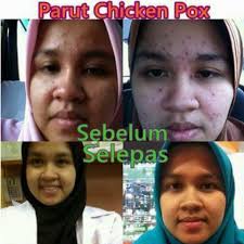 Cara Hilangkan Parut Demam Campak Berlubang Dengan Cepat Dan Berkesan Pengedar Shaklee Alor Setar