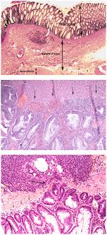 Rectal cancer is cancer that begins in the rectum. Major Histopathological Subtypes Of Canine Colorectal Tumors Download Scientific Diagram