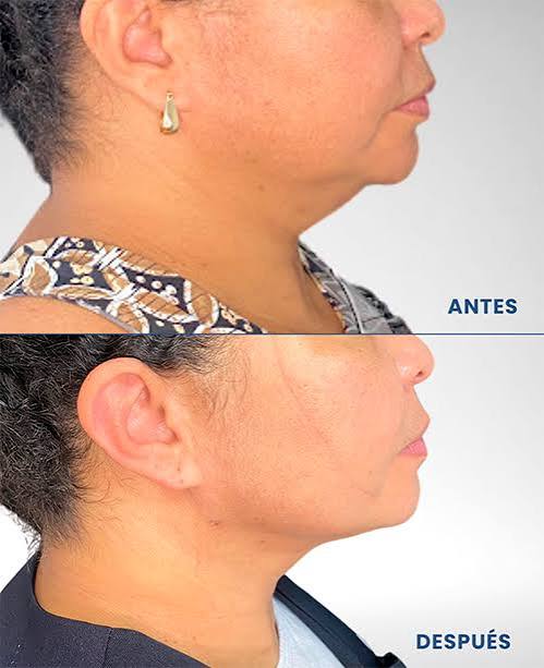 Lipoaspiración de Papada en Santiago — Perfil Definido