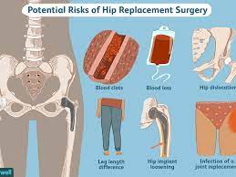 Crowdfunding for surgery has also become nearly as routine as. Hip Replacement Surgehip Replacement Surgery Overviewry Things To Consider