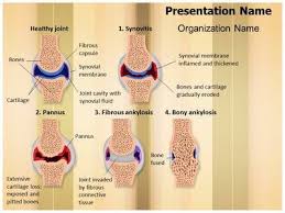 Check Out Our Professionally Designed And World Class Synovial Rheumatoid Arthritis Stages Ppt Temp Powerpoint Powerpoint Presentation Templates Templates