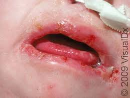 Image result for oral thrush symptoms roof of the mouth