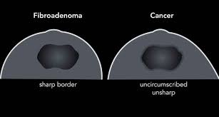 Lumps, tumors and all sorts of things one can feel in the simple imaging techniques, such as a mammogram or breast ultrasound, can usually provide. The Radiology Assistant Ultrasound Of The Breast
