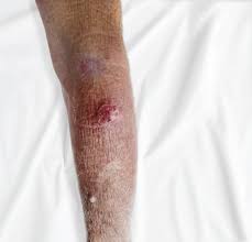 Image result for Nodule