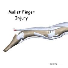 Several types of splint are used, depending partly on the size and shape of. Patient Education Concord Orthopaedics