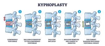 Image result for Kyphocarpa