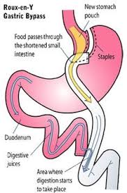 Information On Roux En Y Gastric Bypass And My Personal Reasons For Having It Rny Gastric Bypass Bariatric Surgery Recipes Gastric Bypass Surgery