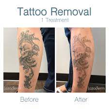 Tattoo removal volunteers—mds, nps, pas, and rns jails to jobs is in the process of expanding its tattoo removal program and is looking for sf bay area volunteer doctors, nurse practitioners, nurses and physicians assistants to help us in our efforts. Laser Tattoo Removal In Chandler Az Free Consultation Lazaderm Laser Aesthetics