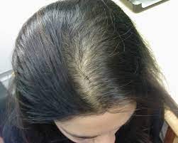 Scientists have already invented many reliable frontal hair loss treatments that are readily available in many developed countries. What Is Frontal Hair Loss Its Causes And Treatment Tips Stylish Walks