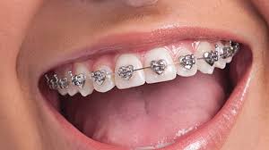 Kids Can Go Wild For Multi Shaped Braces Dental Tribune Usa