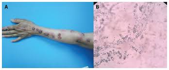 Image result for Nodular Lymphangitis